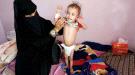 مصادر طبية: ألفا يمني ماتوا بالملاريا خلال شهرين.