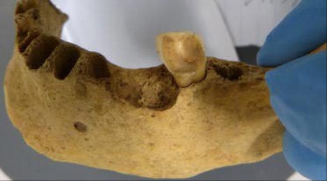 هل كانت أسنان البشر القدماء تسوس.. وما علاقة غذائنا؟ ...